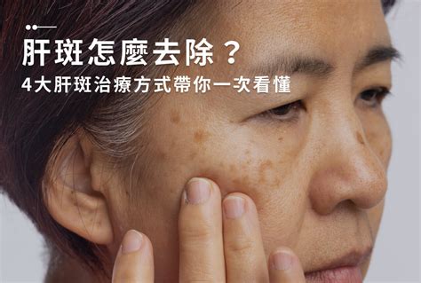 臉頰有斑|一次解析曬斑、肝斑、雀斑、顴骨母斑等皮膚黑斑原因…